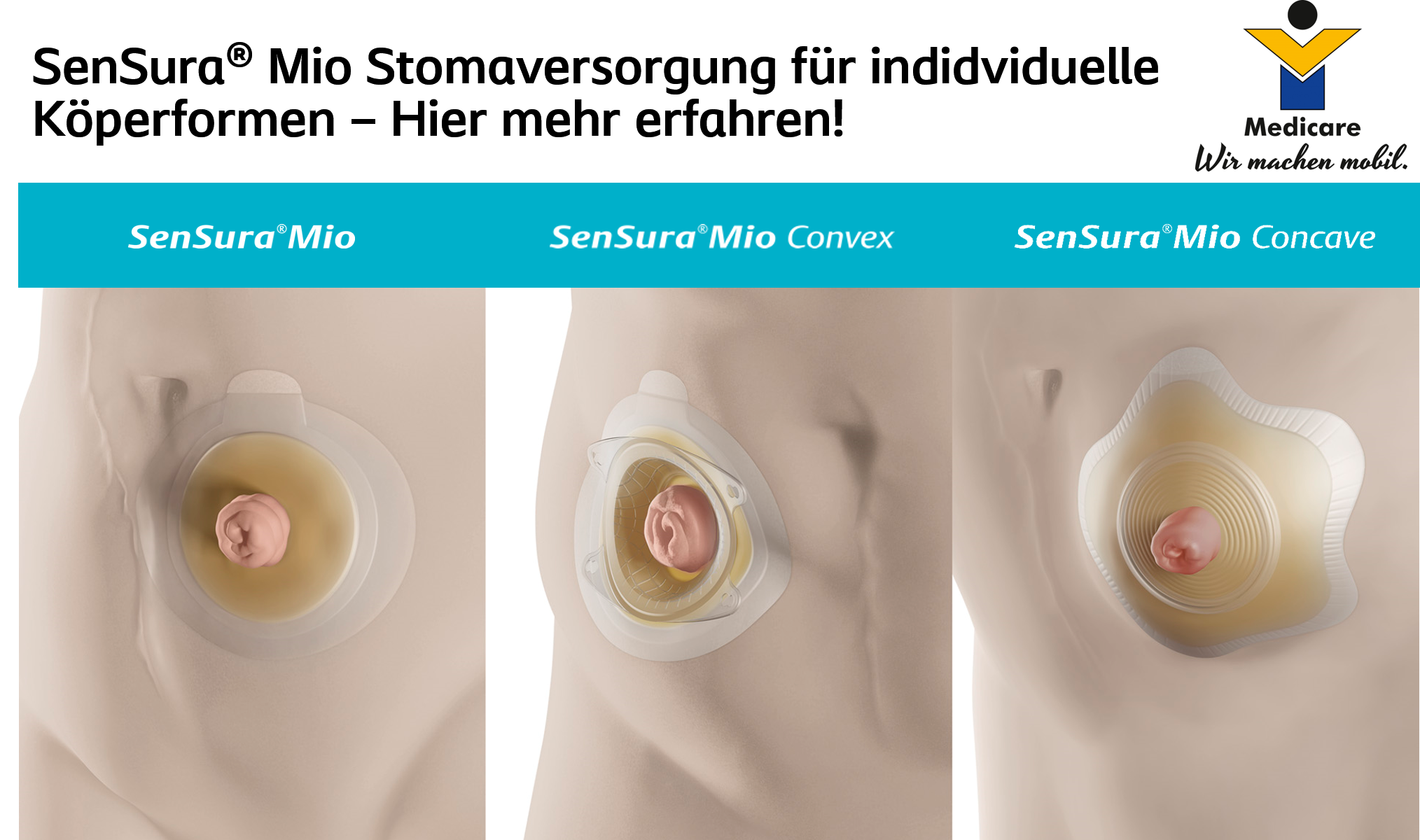 SenSura Mio - Stomaversorgung für individuelle Körperformen